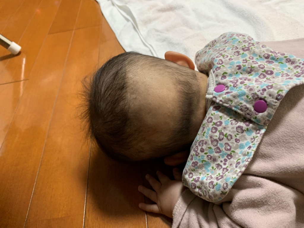 とさかde寝ハゲ
