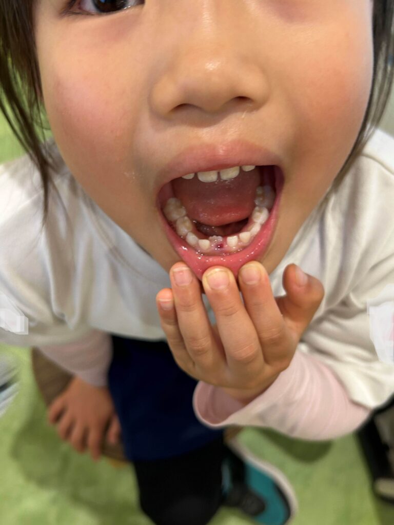 歯が抜けた！　